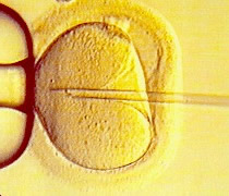 ICSI: The injection of a single sperm into an oocyte.