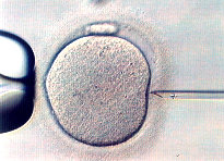 Intra Cytoplasmic Sperm injection, the sperm can be seen in the tip of the injection pipette just prior to injection.