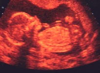Ultrasound scan of a fetus at 19.5 weeks gestation