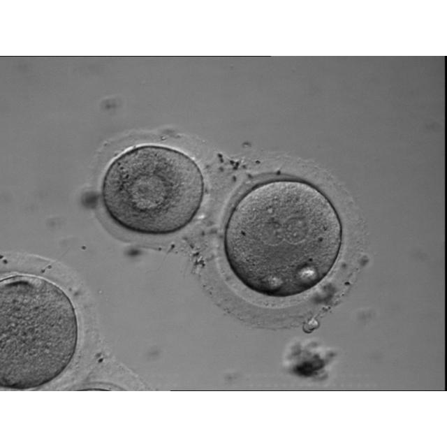 Image shows a 2PN human day 1 zygote conjoined with an immature oocyte, both of which were originally drived from a mature and an immature oocyte respectively. The mature oocyte was fertilized by IVF. 