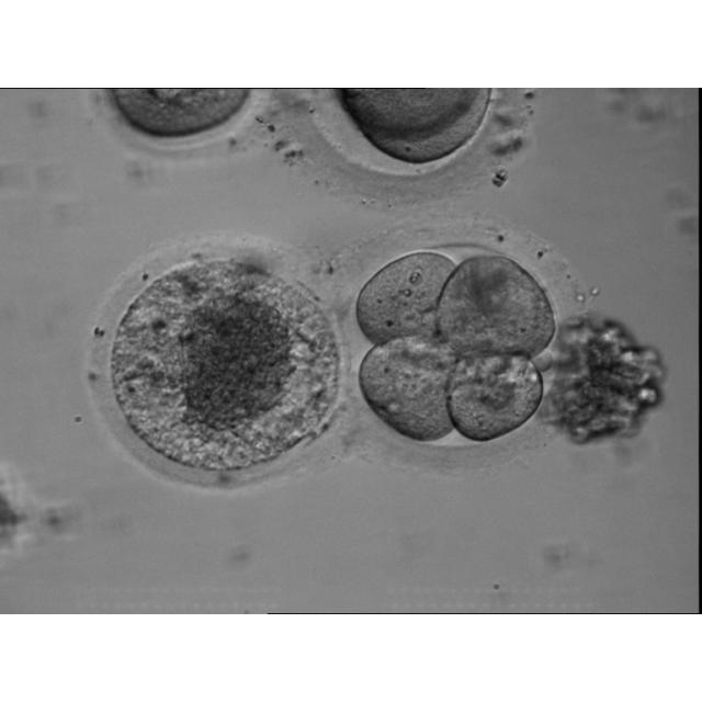 Image shows a 4-cell human day 2 embryo conjoined with an immature oocyte, both of which were originally drived from a mature and an immature oocyte respectively. The mature oocyte was fertilized by IVF and cleaved to 4-cell stage.