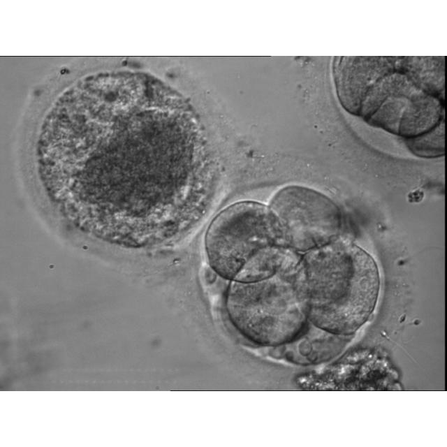 Image shows a 6-cell human day 3 embryo conjoined with an immature oocyte, both of which were originally drived from a mature and an immature oocyte respectively. The mature oocyte was fertilized by IVF and cleaved to 4-cell stage and then to 6-cell stage 