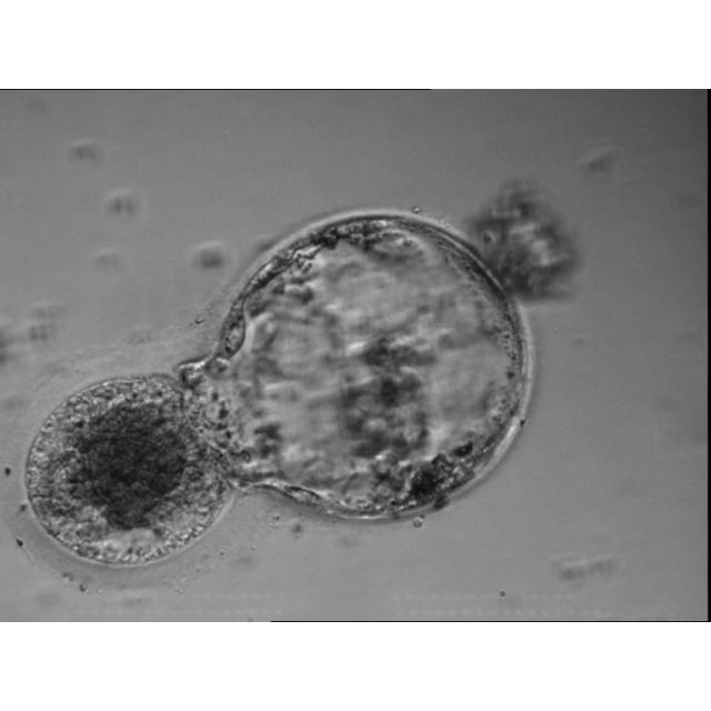 Image shows a human blastocyst conjoined with immature oocyte, both of which were originally drived from immature and mature oocyte. The mature oocyte was fertilized by IVF and cleaved to 4-cell stage then to 6-cell stage and finally to blastocyst stage. While the GV stage oocyte underwent maturity arrest and subsequently degenerated.