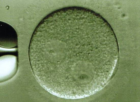 Immature human oocyte with two germinal vesicles