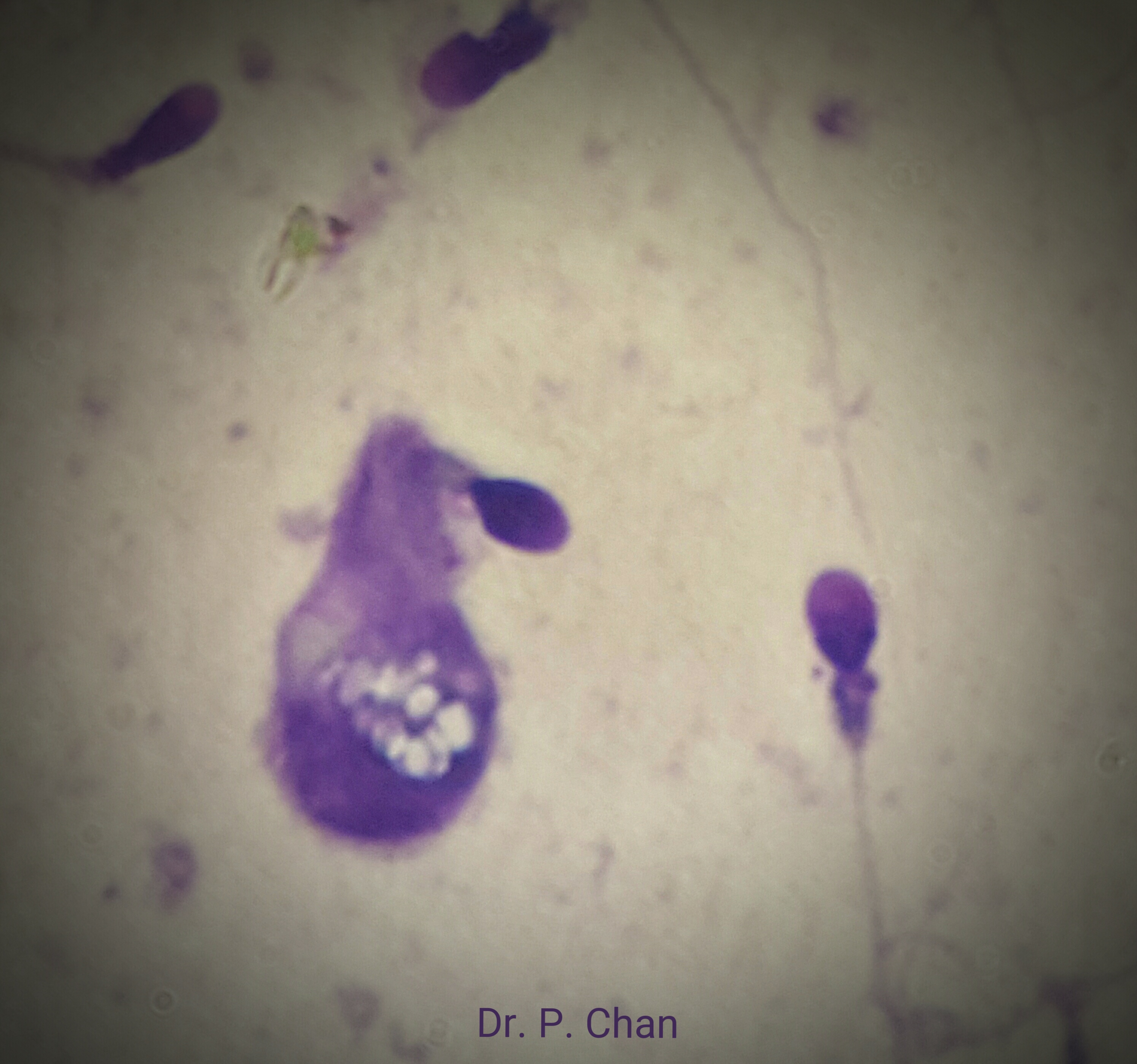 Large cytoplasmic droplet on sperm.