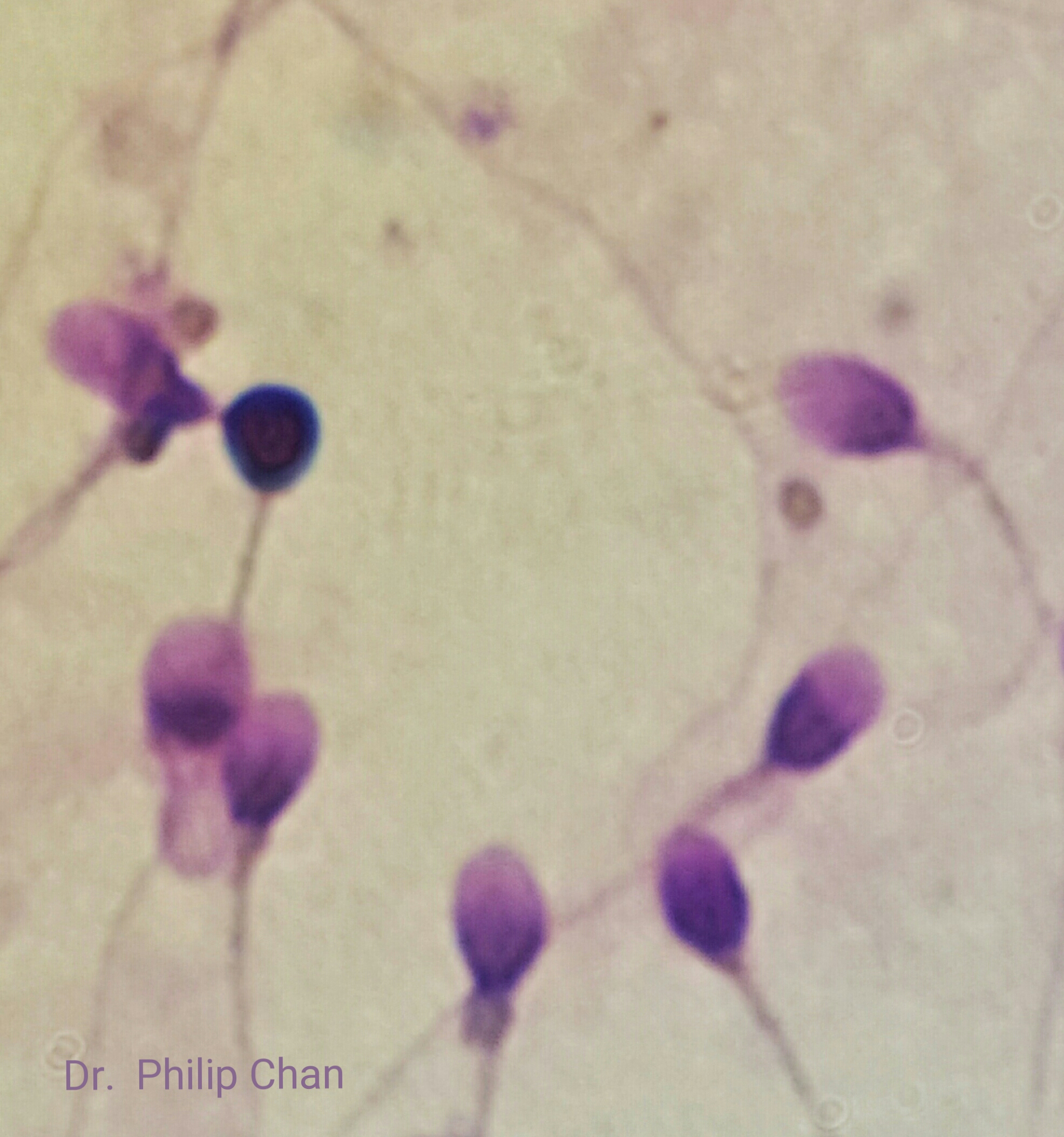 Spot the single DNA damaged sperm? The dark-colored sperm is due to increased dye binding at broken DNA or exposed chromatin structure.