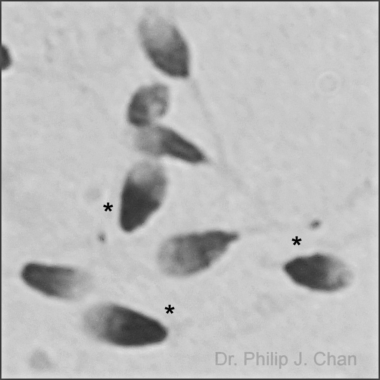 Grey scale photo makes it easier to identify the 3 darker (* asterisk) DNA toroid damaged sperm.